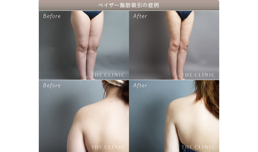 脂肪吸引後にダイエットをした症例