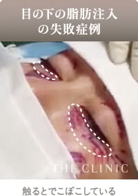目の下の脂肪注入でできたしこり