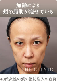 頬の脂肪注入の症例（術前）