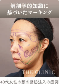 頬の脂肪注入のデザイン