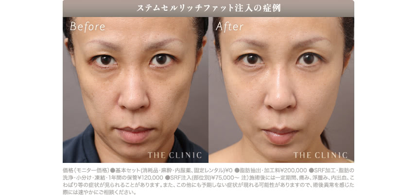 頬の脂肪注入の術前後の比較