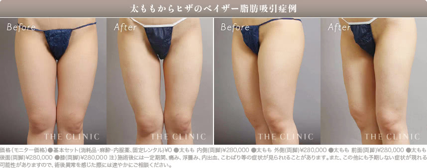 脂肪吸引で部分痩せを叶えた症例