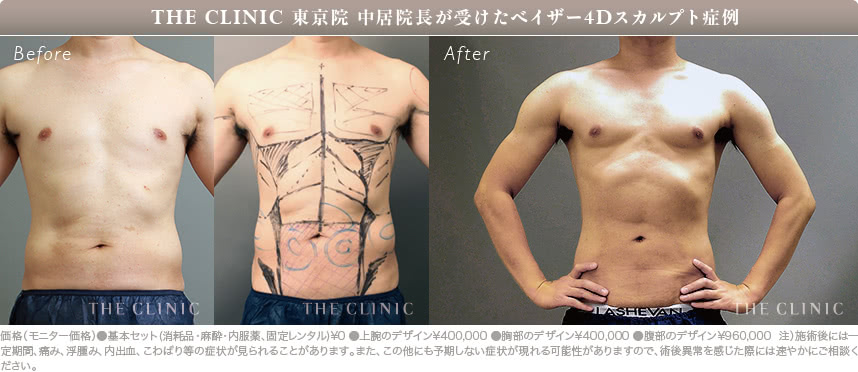 筋肉の強調ができる脂肪吸引