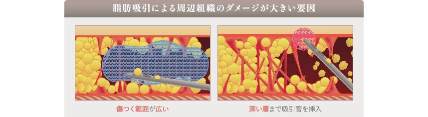 脂肪吸引のダウンタイムについて