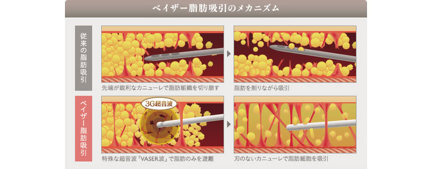 ベイザー脂肪吸引のダウンタイムについて