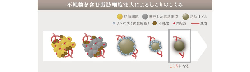 不純物が多いと脂肪の生着を妨げ、体内に吸収されずに壊死した脂肪は、液状またはゴムボール程度の硬いしこりになる。