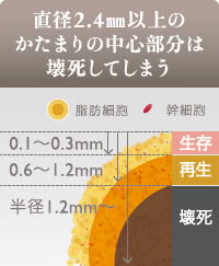 直径2.4mm以上の塊で脂肪を注入すると、中心部の脂肪が壊死してしこりになる。