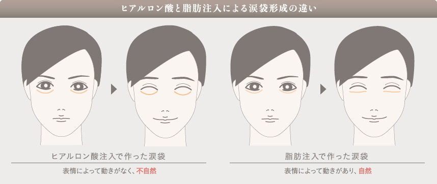 涙袋形成における、ヒアルロン酸と脂肪注入の仕上がりの違い