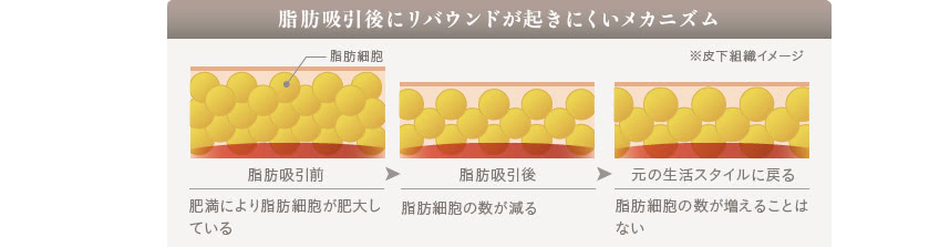 脂肪吸引でリバウンドしにくい理由