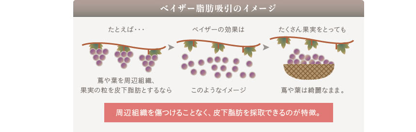 ベイザー脂肪吸引のメカニズム