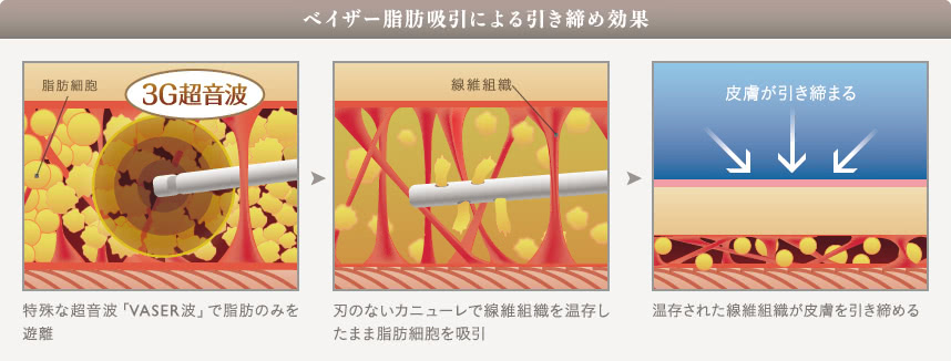 ベイザー脂肪吸引による引き締めイメージ