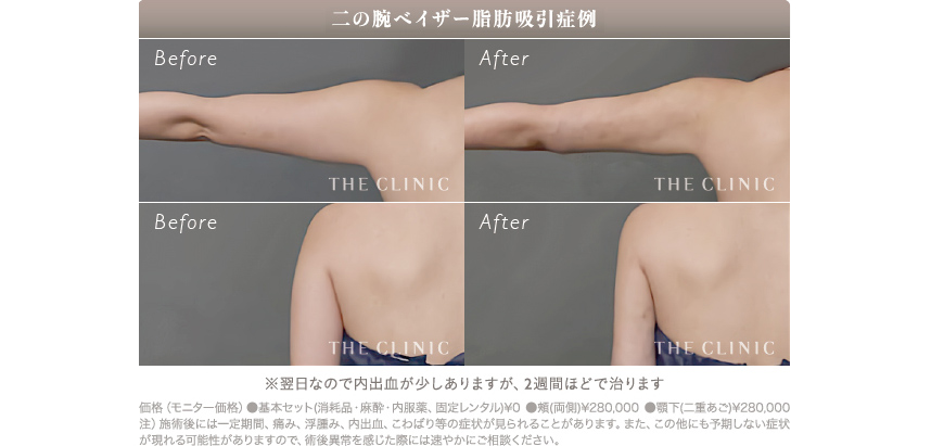 二の腕の脂肪吸引の経過(術前と翌日の比較)