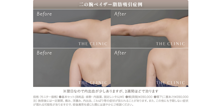 二の腕の脂肪吸引の経過（術前と翌日の比較）