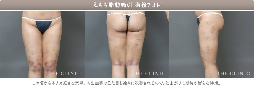 太もも脂肪吸引の翌日の様子