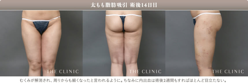 太もも脂肪吸引の10日後の様子