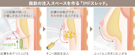 アンダーブーブ豊胸