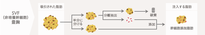 SVF(非培養幹細胞)豊胸