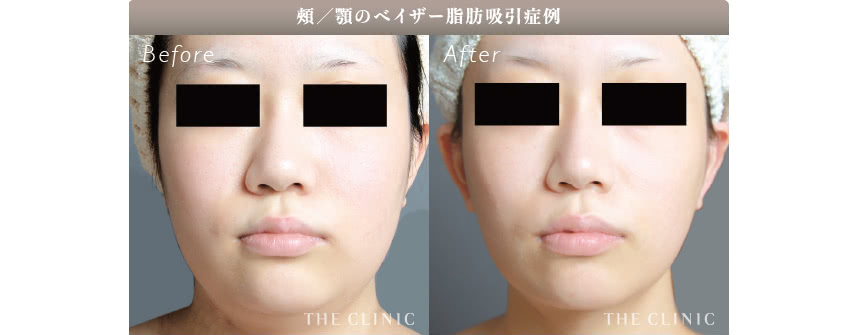 顔の脂肪吸引の症例