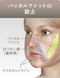 バッカルファット除去の効果