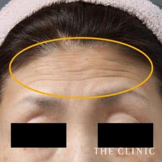 症例写真 / マイクロCRF注入(顔の脂肪注入) 術前