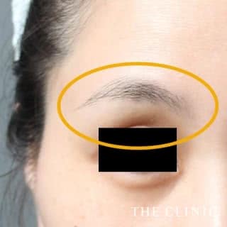 症例写真 / マイクロCRF注入(顔の脂肪注入) 術前