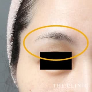 症例写真 / マイクロCRF注入(顔の脂肪注入) 術後