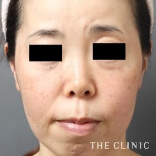 症例写真 / マイクロCRF注入(顔の脂肪注入) 術前