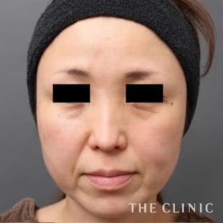 症例写真 / マイクロCRF注入(顔の脂肪注入) 術前