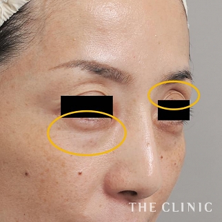 症例写真 / マイクロCRF注入(顔の脂肪注入) 術前