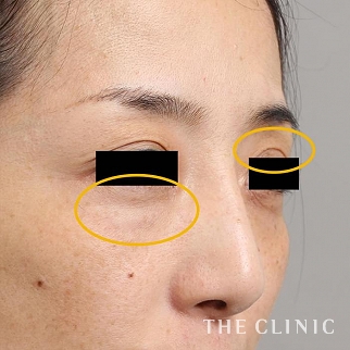 症例写真 / マイクロCRF注入(顔の脂肪注入) 術後