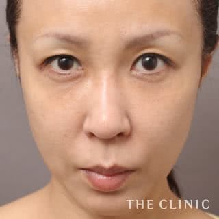 症例写真 / SRF注入(顔の脂肪注入) 術後