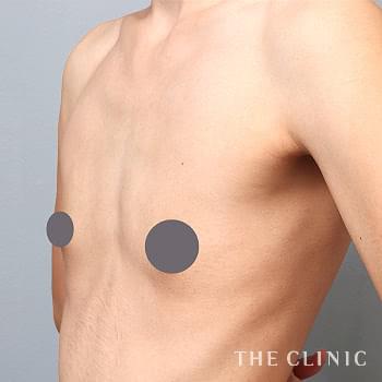 症例写真 / コンデンスリッチ豊胸 術前