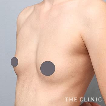 症例写真 / コンデンスリッチ豊胸 術後