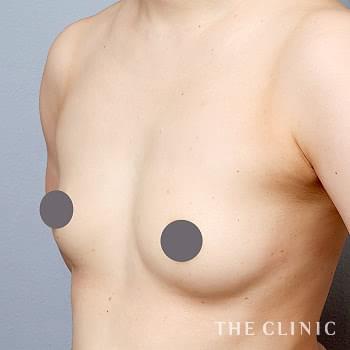 症例写真 / コンデンスリッチ豊胸 術前