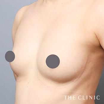 症例写真 / コンデンスリッチ豊胸 術後