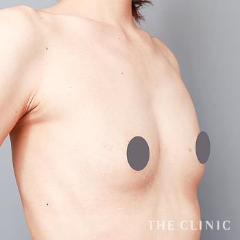 症例写真 / 上向きバスト豊胸 術前