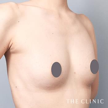 症例写真 / 上向きバスト豊胸 術後