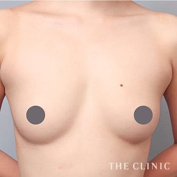 症例写真 / コンデンスリッチ豊胸 術前