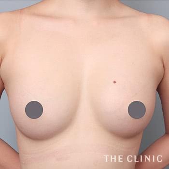 症例写真 / コンデンスリッチ豊胸 術後