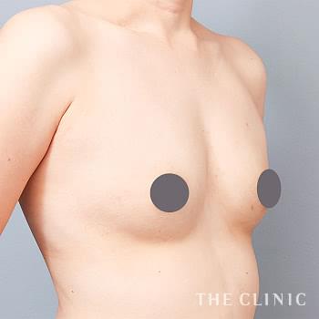 症例写真 / コンデンスリッチ豊胸 術前