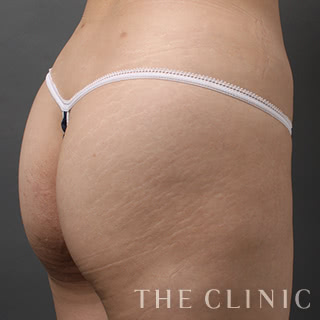 症例写真 / ベイザー4Dリポ 術後