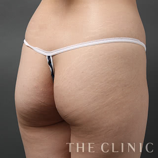 症例写真 / ベイザー4Dリポ 術前