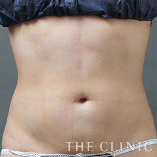 症例写真 / ベイザー4Dリポ 術後