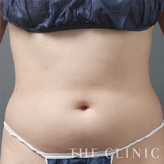 症例写真 / ベイザー4Dリポ 術前