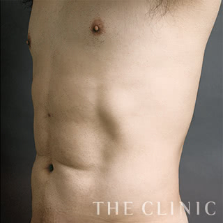 症例写真 / ベイザー4Dリポ 術後