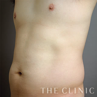 症例写真 / ベイザー4Dリポ 術前