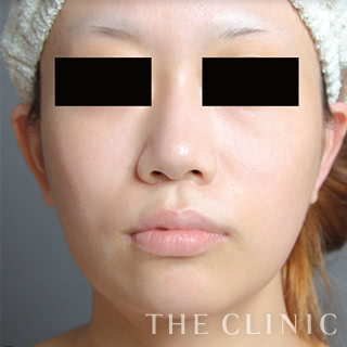 症例写真 / ベイザー脂肪吸引 術後