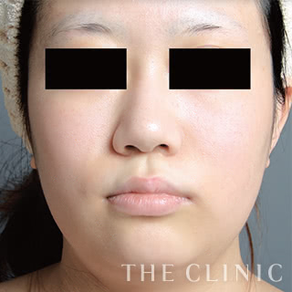 症例写真 / ベイザー脂肪吸引 術前