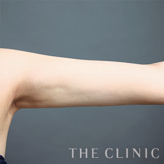 症例写真 / ベイザー脂肪吸引 術後