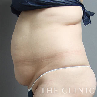 症例写真 / ベイザー脂肪吸引 術前